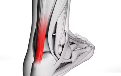 HOW PHYSICAL THERAPY CAN ALLEVIATE YOUR TENDON PROBLEMS