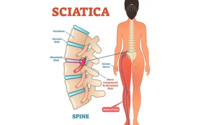 Addressing Sciatic Pain: Start Early for Best Results